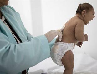 US health officials confirm Zika cause of severe birth defects
