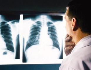 12 X-ray technicians at faculty hospital diagnosed with thyroid cancer in Turkey
