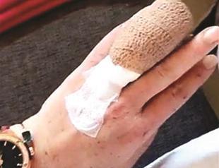 Lindsay Lohan’s finger partially severed in accident in Turkey’s south