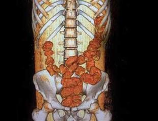 Drug-filled condoms found in man’s stomach in Istanbul airport