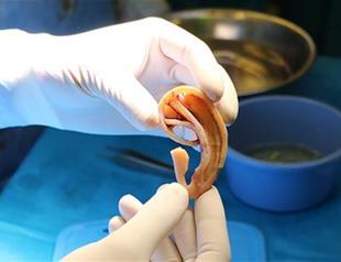 Patient in southern Turkey given new ears created from his mother’s rib cartilage