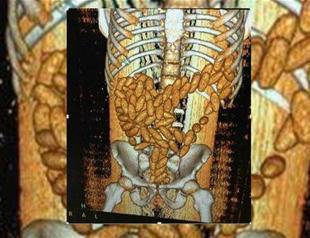 Half kilogram of cannabis found in Moroccan man’s digestive system in Istanbul