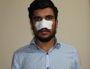 Local man bites off his cousin’s nose during dispute in Turkey’s southeast