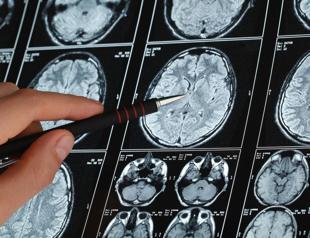 30 pct of Turkish epilepsy patients consult with exorcists, spiritualists