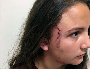12-year-old girl gets 52 stitches after pitbull attack in Turkey’s Tekirdağ