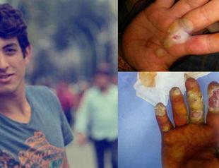 Turkish teen’s life turns to hell after confusing radioactive material for prayer beads