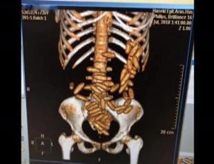 Brazilian woman caught in Istanbul airport with 51 cocaine capsules in her stomach