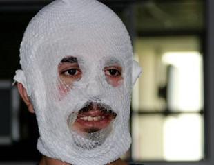 Moisturizer ‘burns’ Turkish man’s face