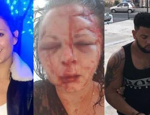 British woman ‘unrecognizable’ due to attack by male compatriot in Marmaris