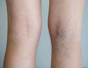 Circulatory diseases lead causes of death in Turkey: Report