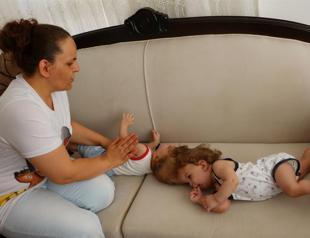 Conjoined Turkish twins celebrate first birthday