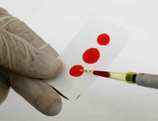 Silent disease hepatitis affecting millions