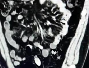 Police detain man carrying drug pills in stomach