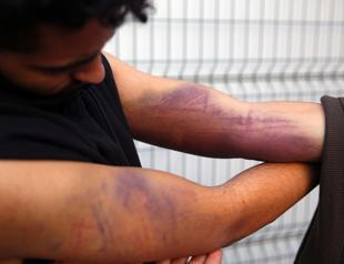 Migrants beaten by Greek troops get treatment in Turkey