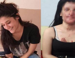 Woman who survived acid attack forgives her abuser