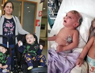 Turkish conjoined twin return after successful op in UK