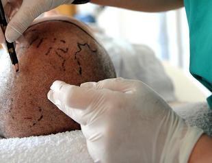 Turkey witnesses rising interest in hair transplants amid pandemic: Expert