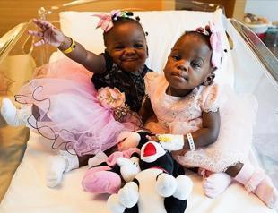 Conjoined Cameroonian twin sisters separated in Istanbul