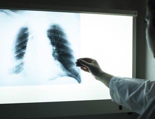 Over 27,000 diagnosed with lung cancer annually in Turkey