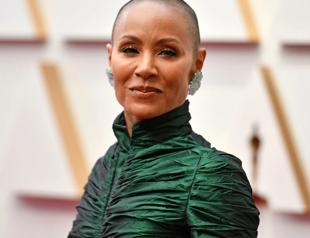 Hair loss: Women speak of the pain of going bald