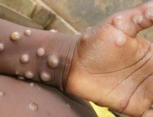 Spanish monkeypox outbreak linked to sauna