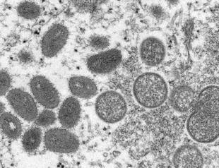Israel reports first case of monkeypox, suspects others