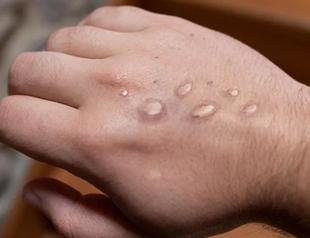 More than 700 monkeypox cases globally, 21 in US: CDC