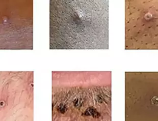 Monkeypox vaccine maker Bavarian Nordic ready to meet demand