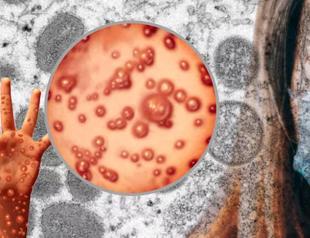 UN health agency chief declares monkeypox a global emergency