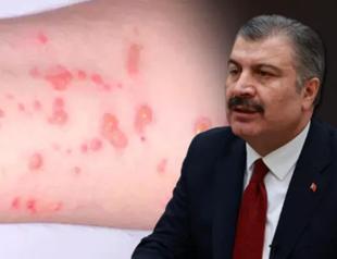 Five monkeypox cases detected in Türkiye: Minister