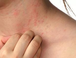 Scabies cases on rise for two years, experts warn