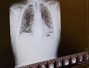 Pill halves risk of death in type of lung cancer