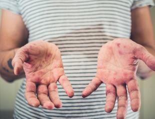 Istanbul hospitals face an alarming rise in measles cases