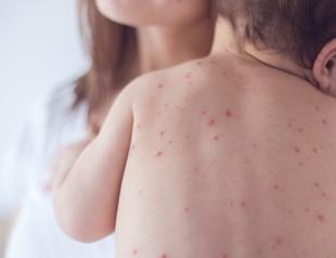 86 pct of measles cases in Istanbul: Koca