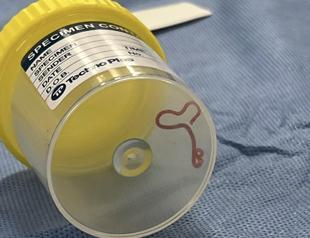 Live worm found in womans brain