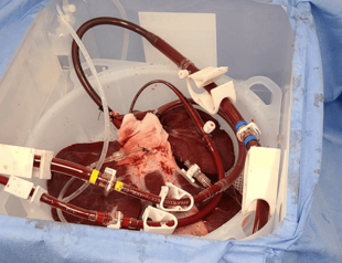 A first-ever experiment shows pigs might help liver failure