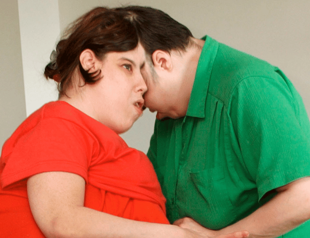 Oldest living conjoined twins die at 62