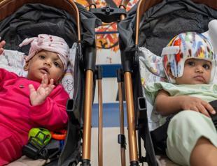 Pakistani conjoined twins separated in 14-hour operations in Türkiye