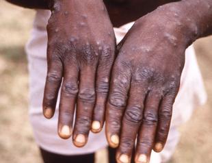 Gambia declares mpox outbreak