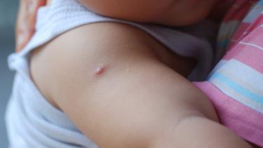 Az biliniyor ama özellikle yaz aylarında görülüyor... Molluscum enfeksiyonu çocukları hedef alıyor