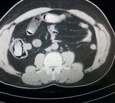 Iranian suspects hiding drugs in stomachs detained at İzmir airport