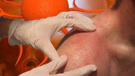 Gençlerde cilt kanseri vakaları artıyor Yanlış güneş kremi kullanımının etkisi büyük… Uzmanlar 13 kritik soruya cevap verdi