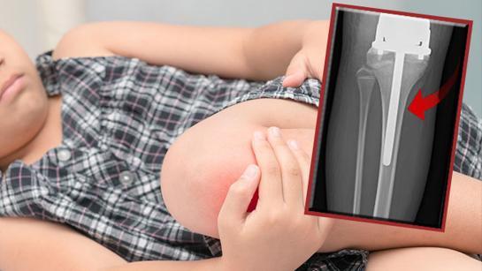 Büyüme ağrısı sandılar, bacağında 26 cm’lik bir tümör tespit edildi | Yürümeyi tekrar öğrenmek zorunda kaldı