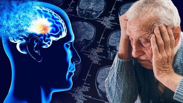 Alzheimer’da yeni tanı yöntemi tartışma yarattı… Milyonlarca sağlıklı insana teşhis konabilir! 