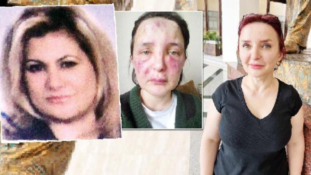 Sahte doktorun yüzünü mahvettiği mağdur kadın Hürriyet’e konuştu: O ismi gördüğünüz yerde kaçın