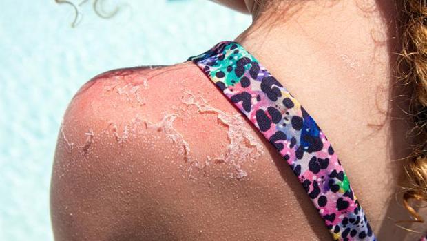 Dikkat! Özellikle çocuklarda çok tehlikeli: 18 yaşından önce bir kez güneş yanığı yaşamak kanser riskini iki kat artırıyor