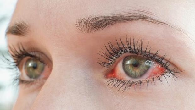 Gözünüzde kuruluk, kızarıklık, yanma ve batma varsa dikkat! Göz alerjileri yaz aylarında neden artıyor? 