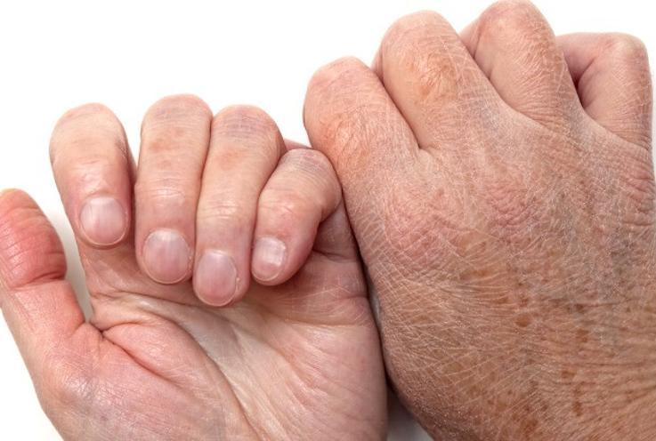 Tırnaklarda Beyaz Leke Neden Olur, Nasıl Geçer?