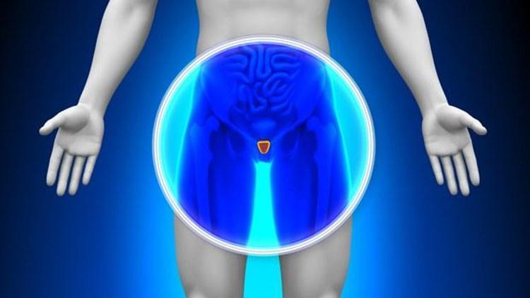 İleri evre prostat kanserine özel çözüm