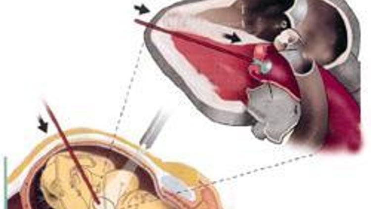 Kalp aortu supabı tıkalı fetüslere, anne karnında başarılı ameliyat yapılıyor